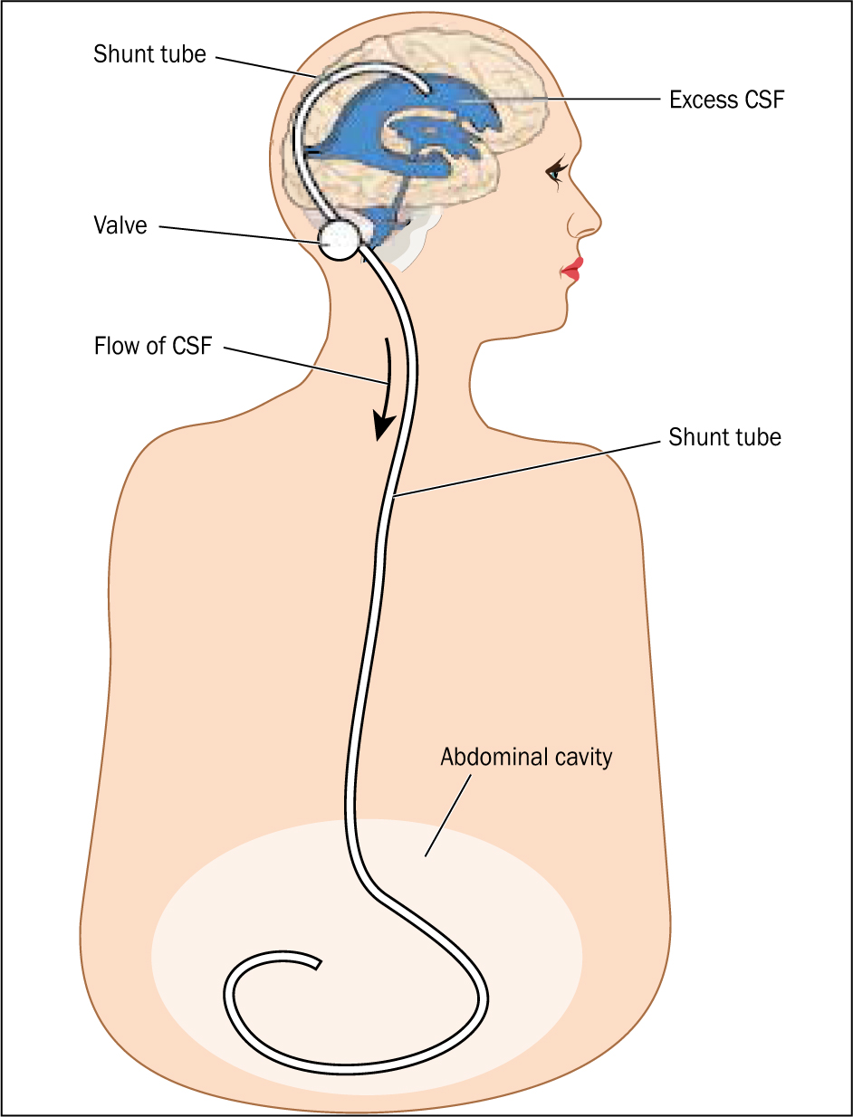 Lumboperitoneal Shunt  Pacific Adult Hydrocephalus Center