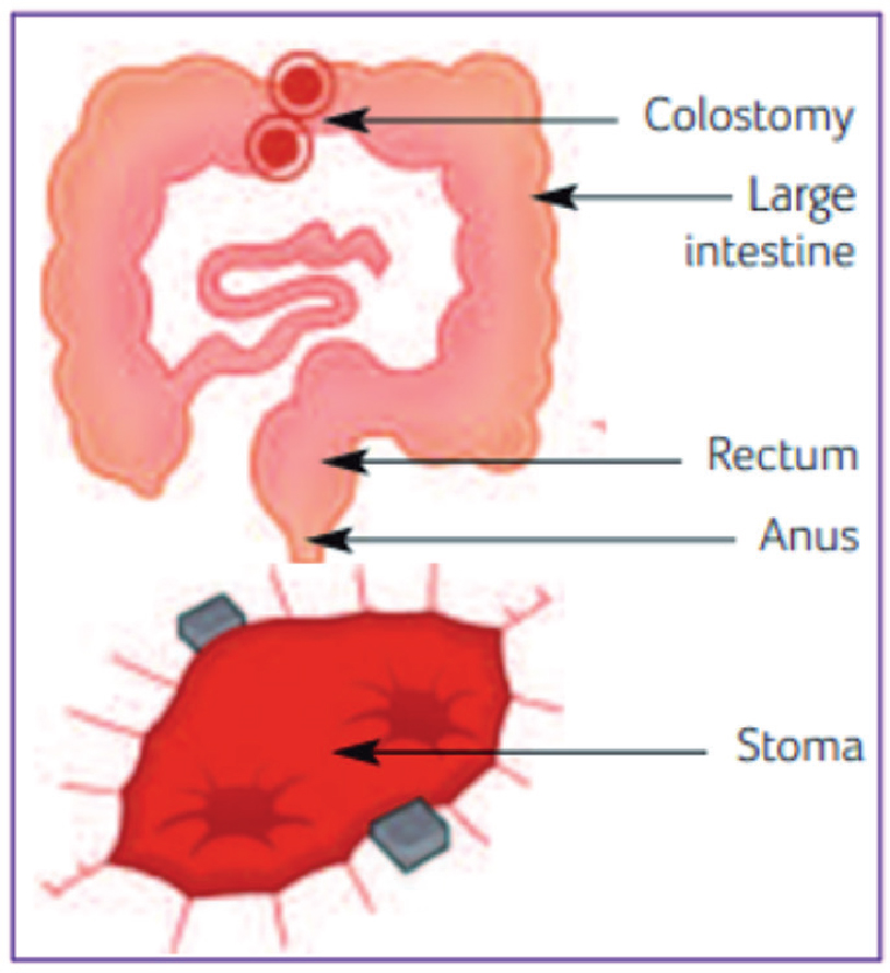 end colostomy