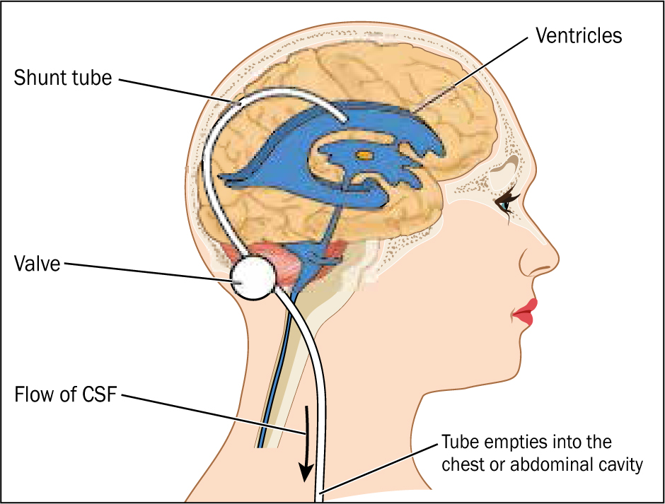 hydrocephalus shunt problems