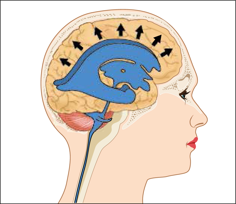 British Journal Of Midwifery - Cerebrospinal fluid shunts in the